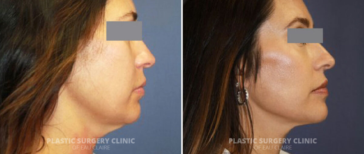 Neck Lift Before and After Photos in Eau Claire, Wisconsin, Patient 1327