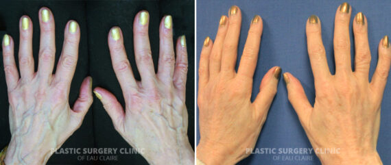 Hand Rejuvenation Before and After Photos in Eau Claire, Wisconsin