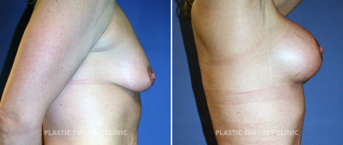 Breast Augmentation Before and After Photos in Eau Claire, Wisconsin, Patient 1433