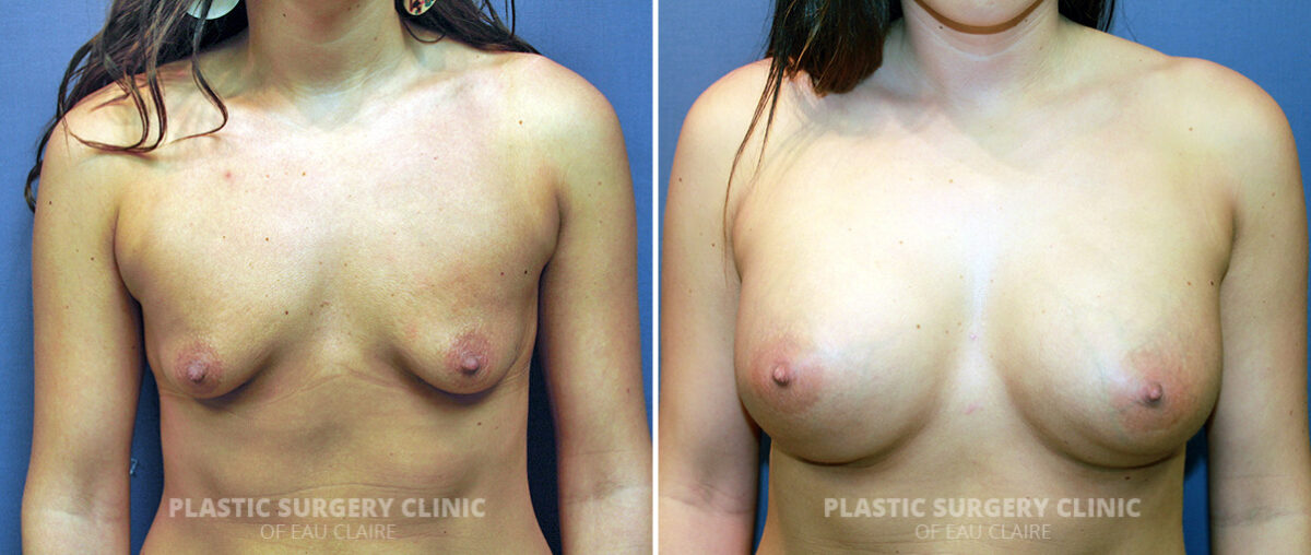 Breast Augmentation Before and After Photos in Eau Claire, Wisconsin, Patient 1440