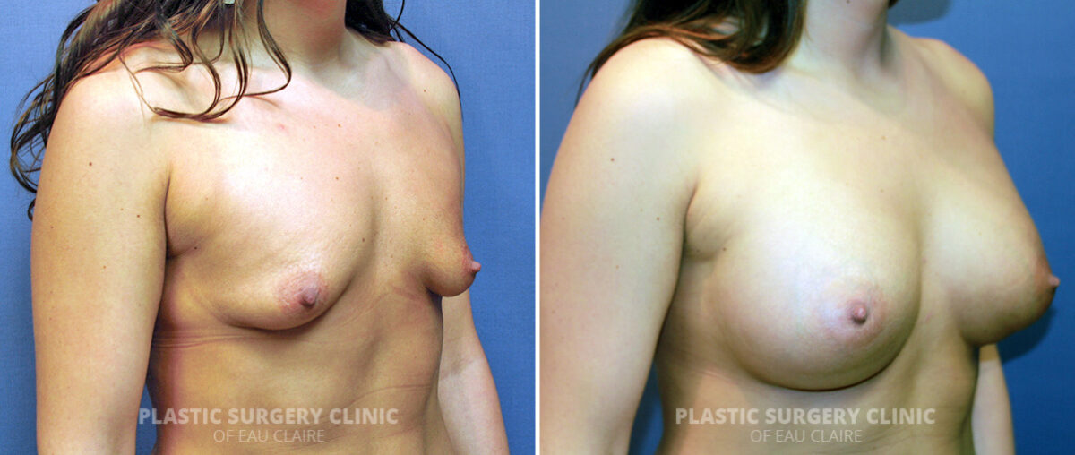 Breast Augmentation Before and After Photos in Eau Claire, Wisconsin, Patient 1440