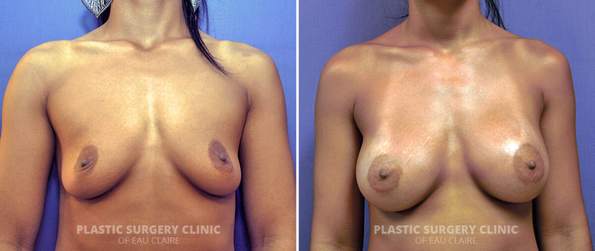 Breast Augmentation Before and After Photos in Eau Claire, Wisconsin, Patient 1454