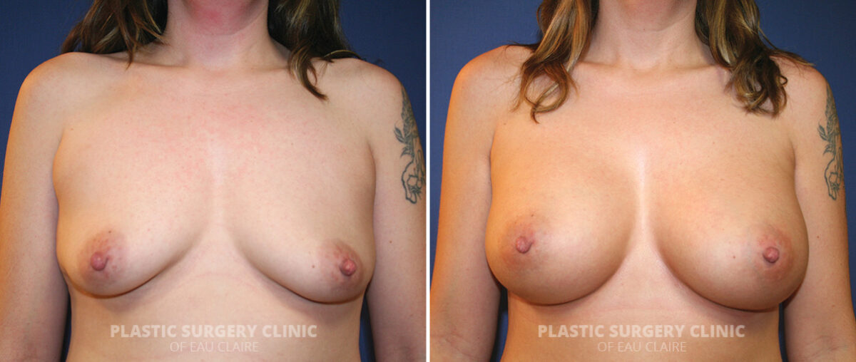 Breast Augmentation Before and After Photos in Eau Claire, Wisconsin, Patient 1469