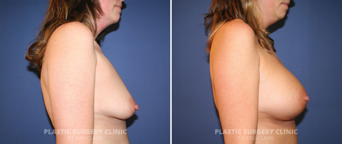 Breast Augmentation Before and After Photos in Eau Claire, Wisconsin, Patient 1469