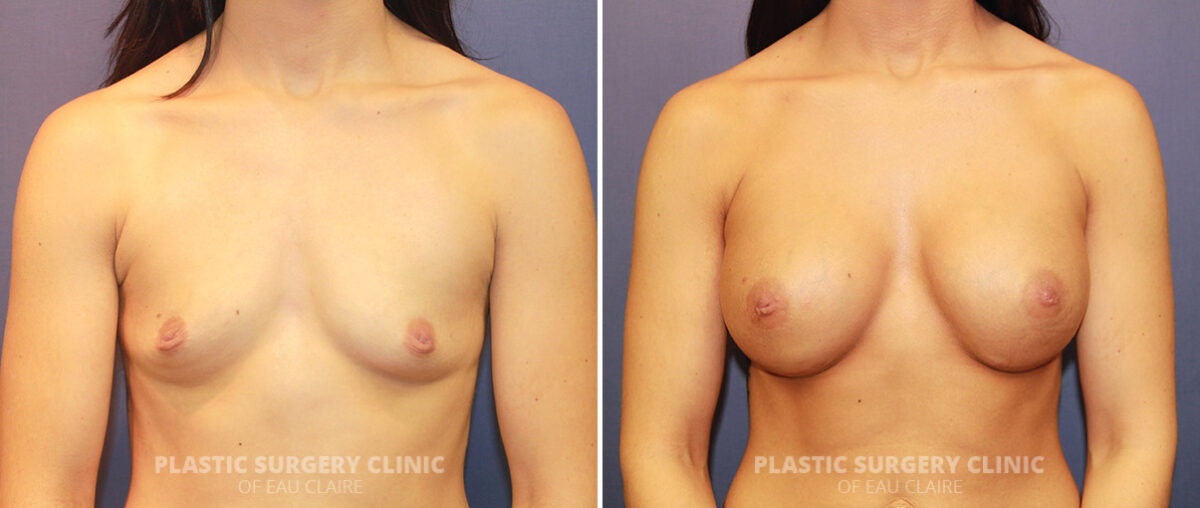 Breast Augmentation Before and After Photos in Eau Claire, Wisconsin, Patient 1476