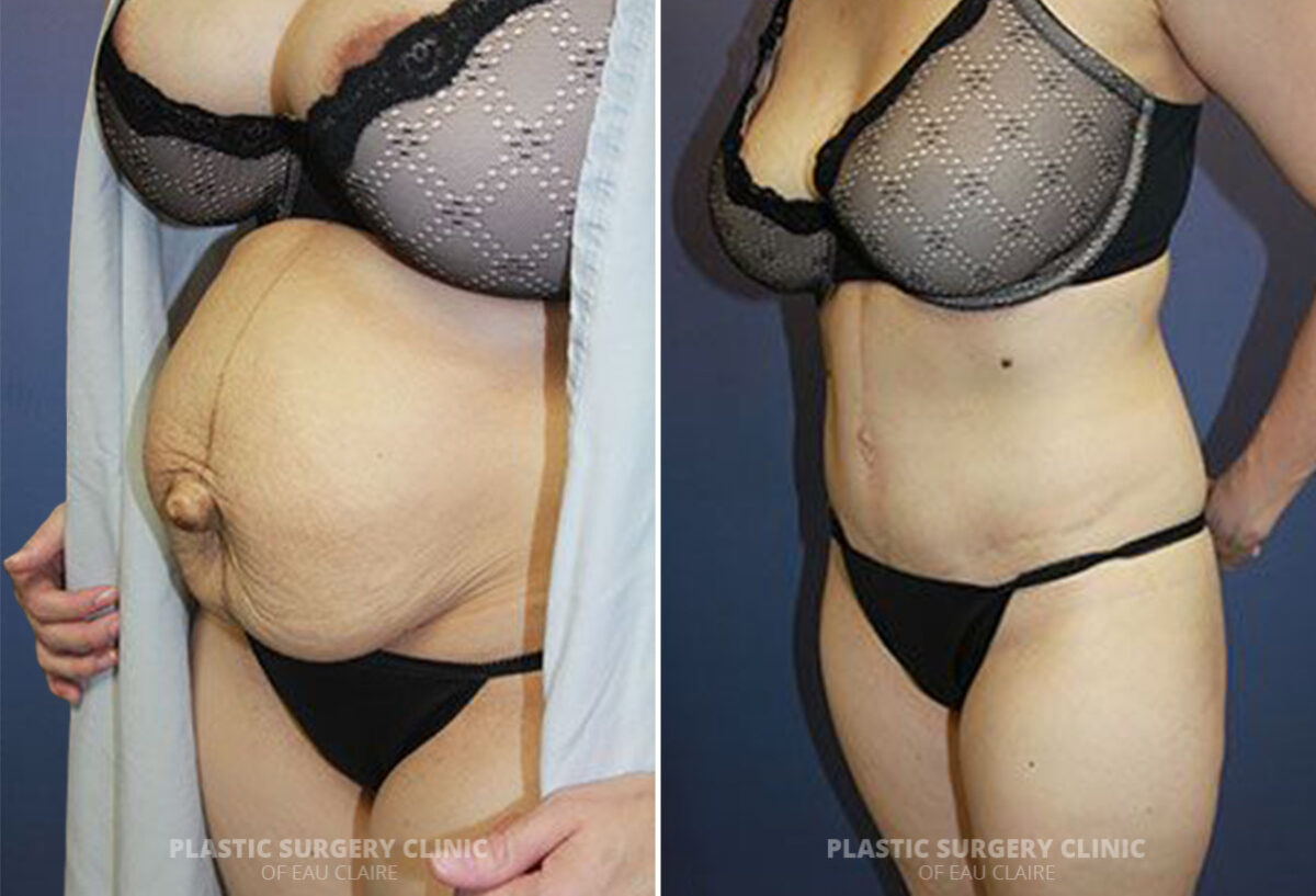 Mommy Makeover Before and After Photos in Eau Claire, Wisconsin, Patient 1487