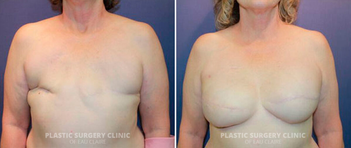 Breast Reconstruction Before and After Photos in Eau Claire, Wisconsin, Patient 153