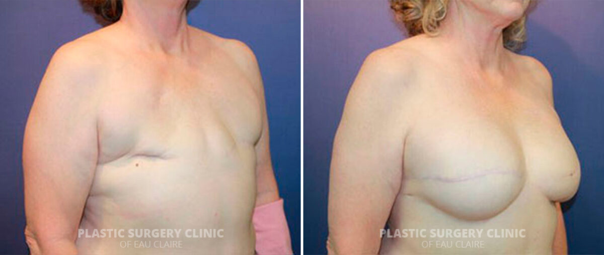 Breast Reconstruction Before and After Photos in Eau Claire, Wisconsin, Patient 153