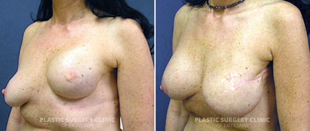 Breast Reconstruction Before and After Photos in Eau Claire, Wisconsin, Patient 156