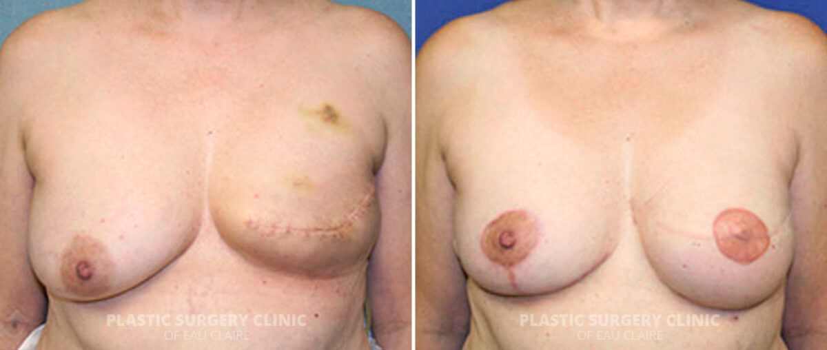 Breast Reconstruction Before and After Photos in Eau Claire, Wisconsin, Patient 158