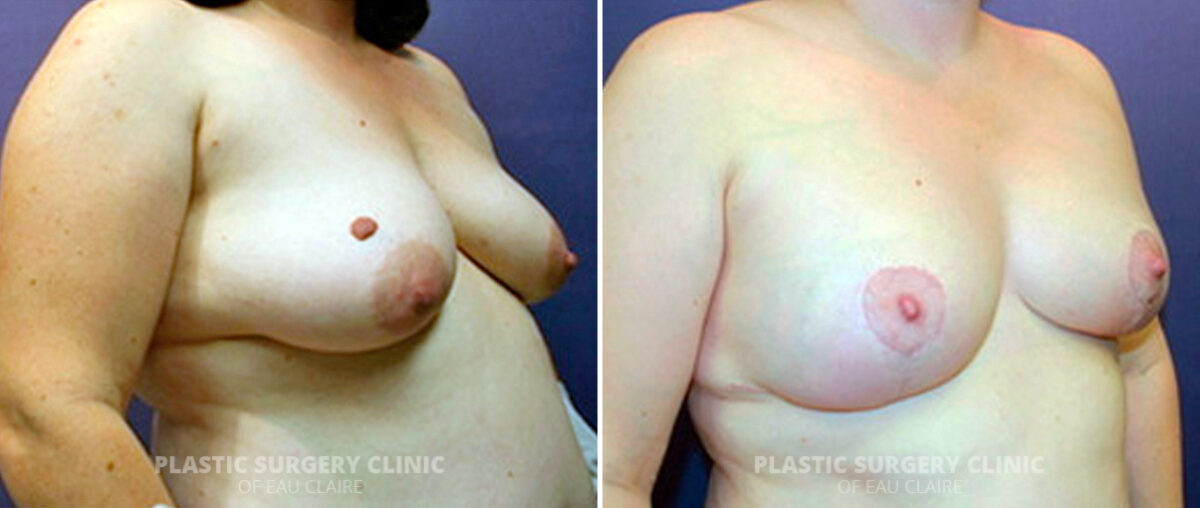 Breast Reconstruction Before and After Photos in Eau Claire, Wisconsin, Patient 160