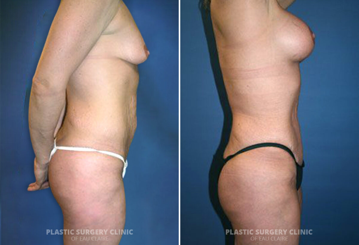 Tummy Tuck Before and After Photos in Eau Claire, Wisconsin, Patient 1608