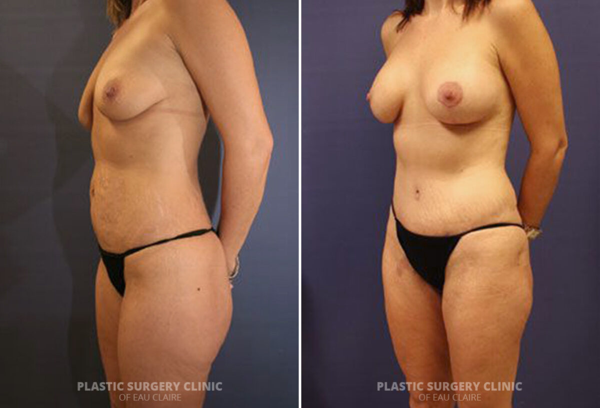 Tummy Tuck Before and After Photos in Eau Claire, Wisconsin, Patient 1615