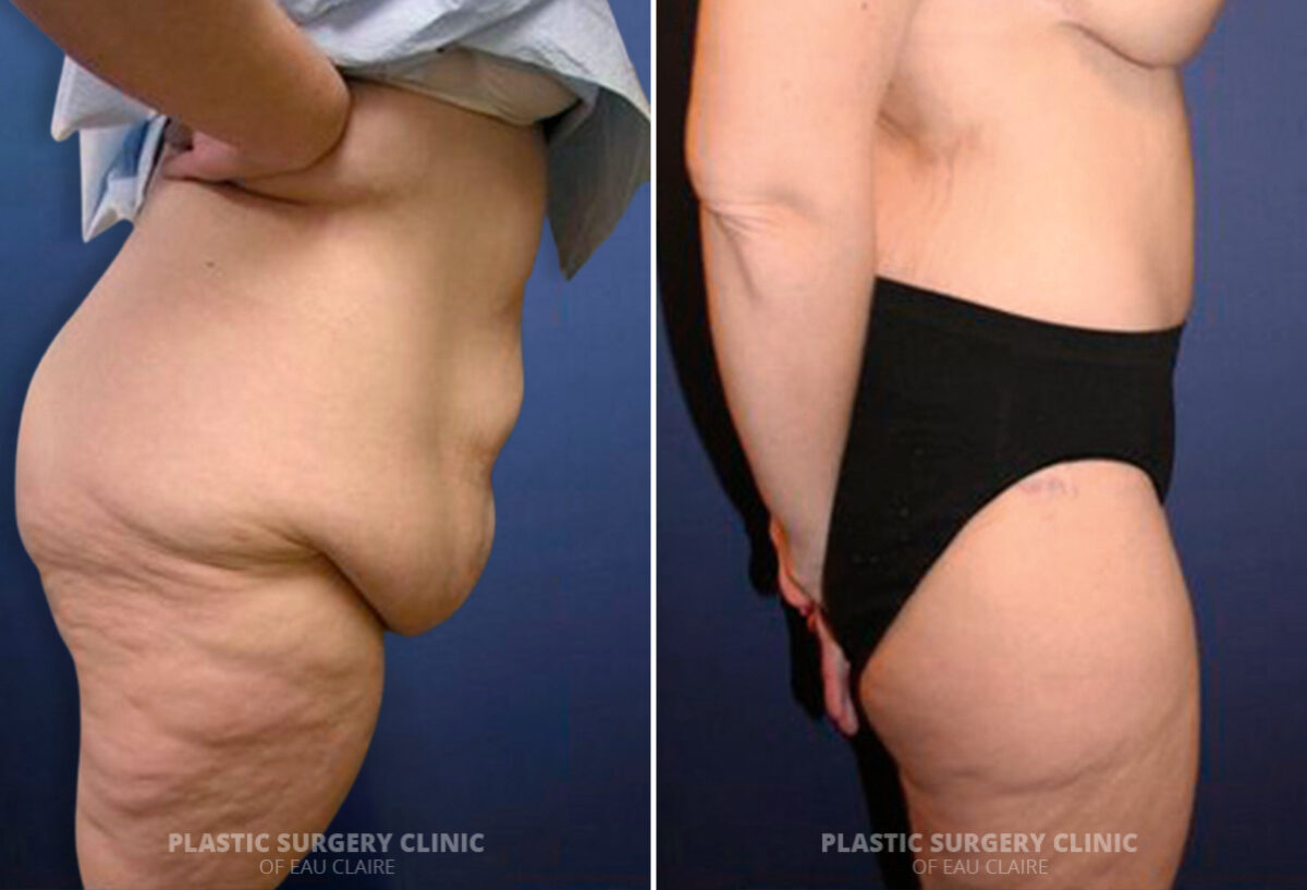 Tummy Tuck Before and After Photos in Eau Claire, Wisconsin, Patient 1622