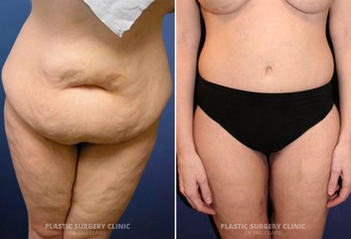 Tummy Tuck Before and After Photos in Eau Claire, Wisconsin, Patient 1622