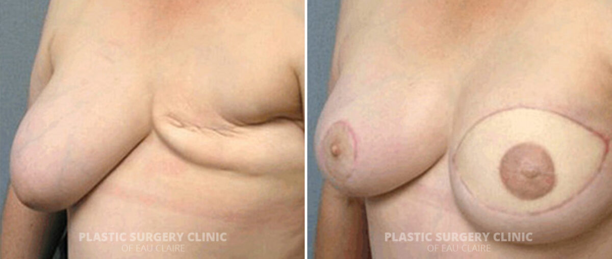 Breast Reconstruction Before and After Photos in Eau Claire, Wisconsin, Patient 164