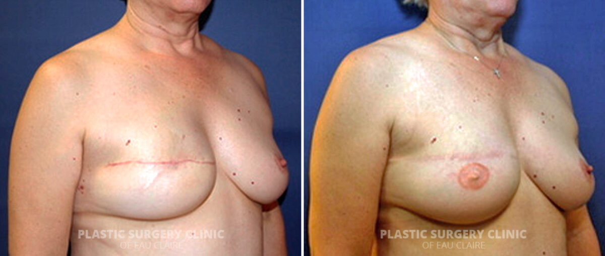 Breast Reconstruction Before and After Photos in Eau Claire, Wisconsin, Patient 166