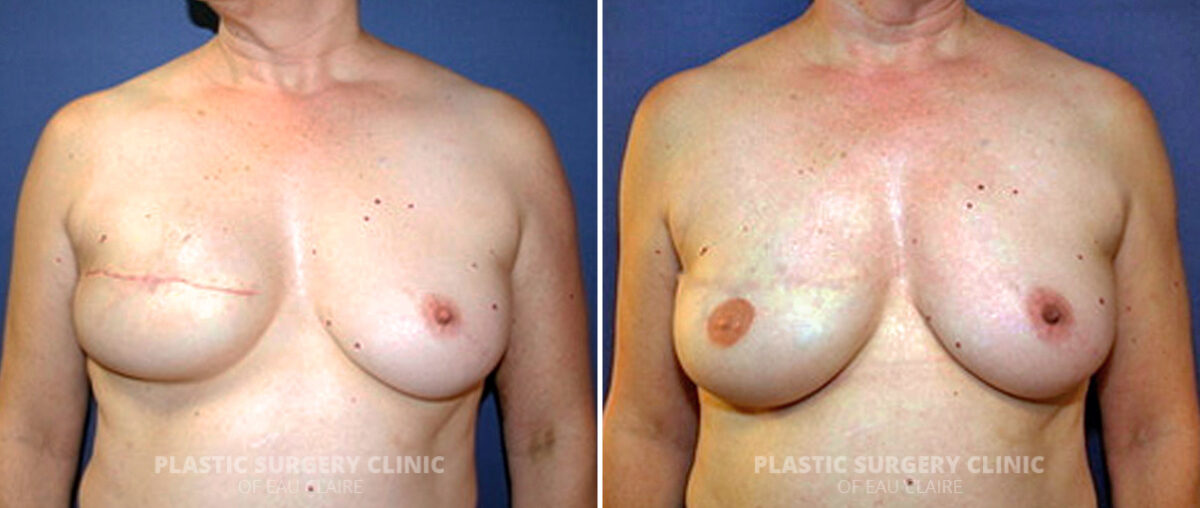 Breast Reconstruction Before and After Photos in Eau Claire, Wisconsin, Patient 166