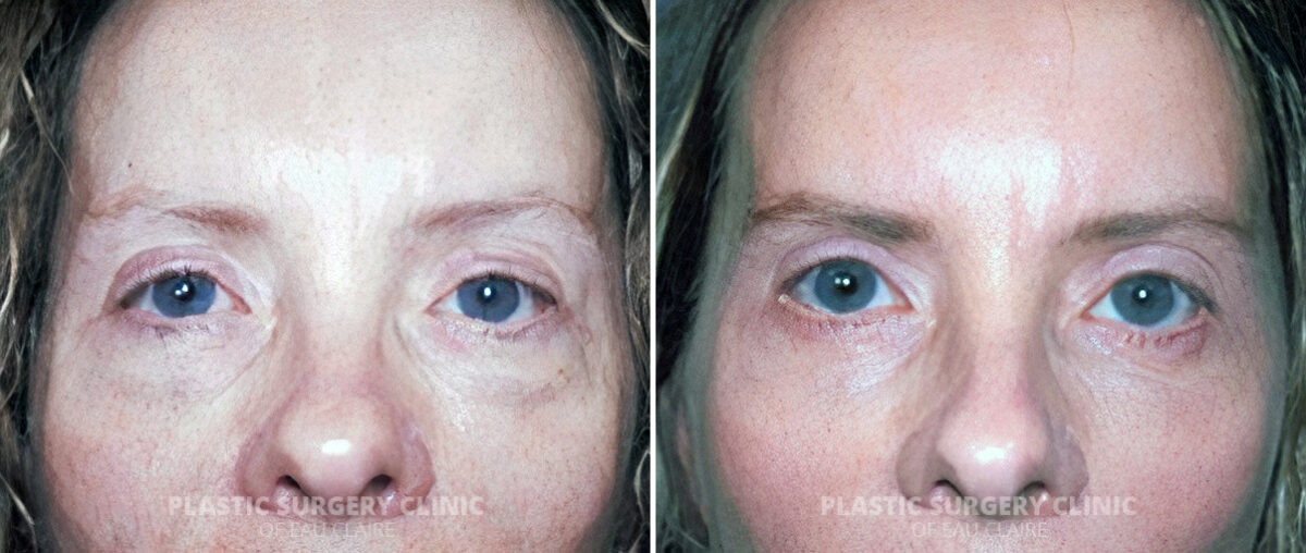 Blepharoplasty Before and After Photos in Eau Claire, Wisconsin, Patient 187