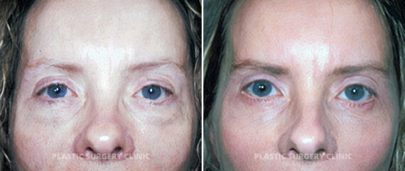 Blepharoplasty Before and After Photos in Eau Claire, Wisconsin