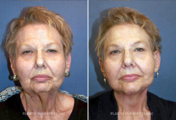 Facelift Before and After Photos in Eau Claire, Wisconsin, Patient 191