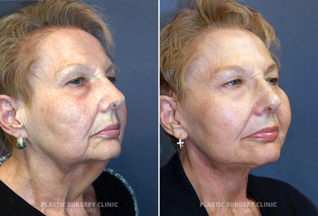 Facelift Before and After Photos in Eau Claire, Wisconsin, Patient 191