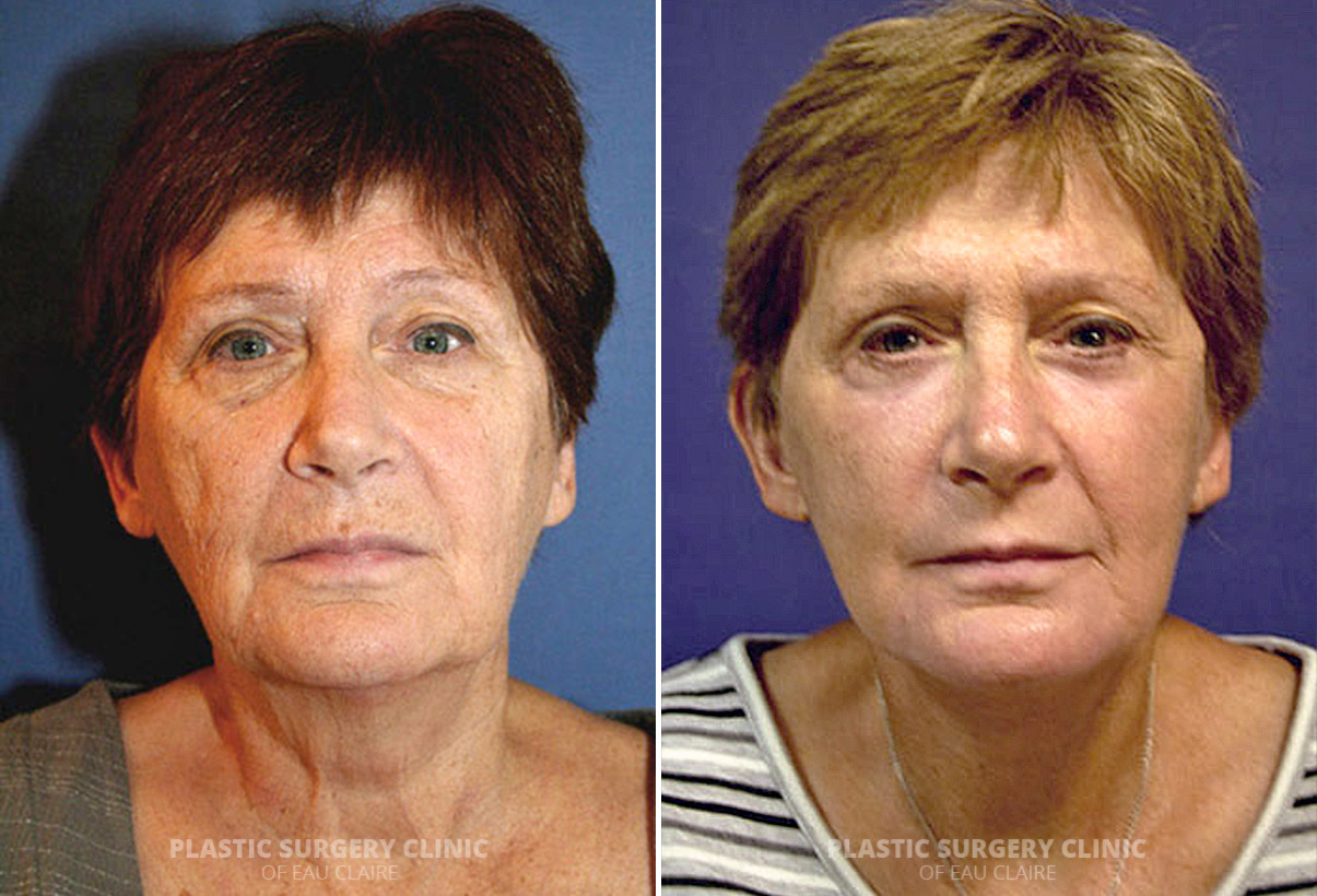 Facelift Before and After Photos in Eau Claire, Wisconsin, Patient 204