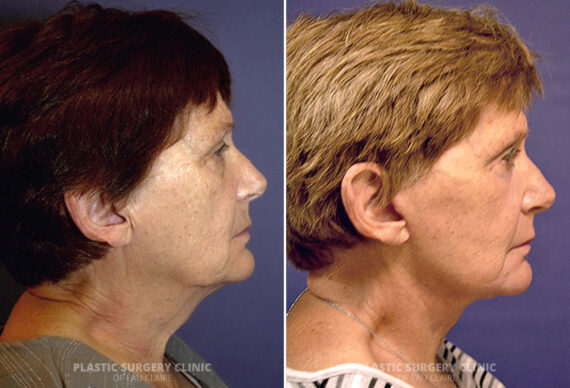 Facelift Before and After Photos in Eau Claire, Wisconsin, Patient 204