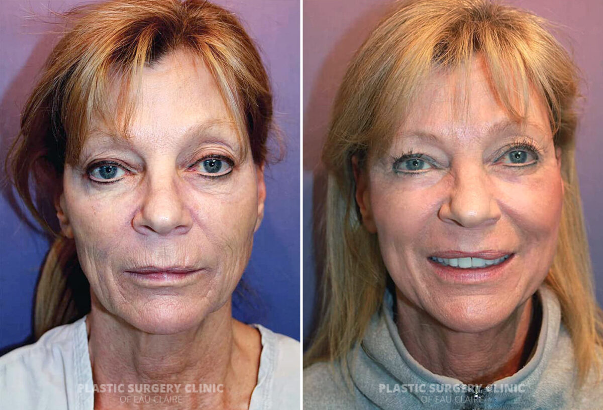 Laser Resurfacing Before and After Photos in Eau Claire, Wisconsin, Patient 2338