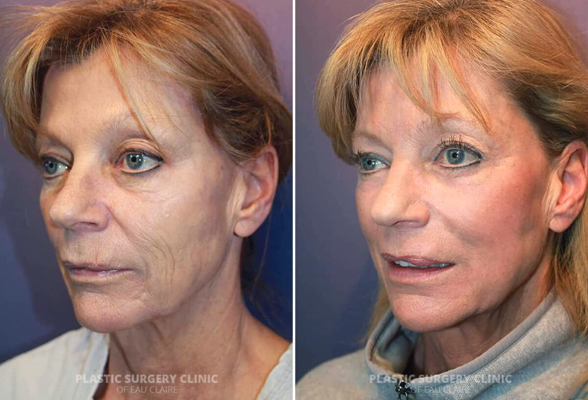 Laser Resurfacing Before and After Photos in Eau Claire, Wisconsin, Patient 2338