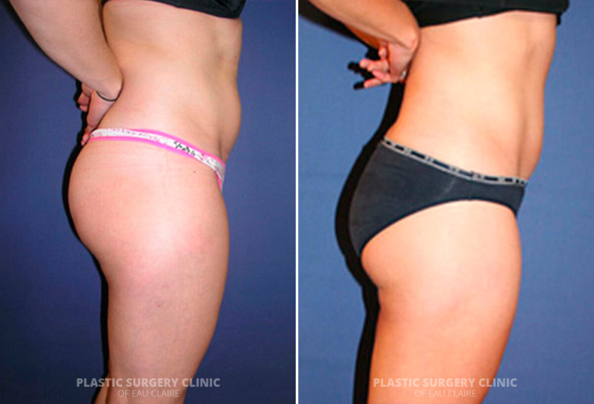 Liposuction Before and After Photos in Eau Claire, Wisconsin, Patient 237