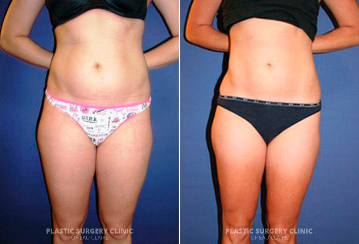 Liposuction Before and After Photos in Eau Claire, Wisconsin, Patient 237