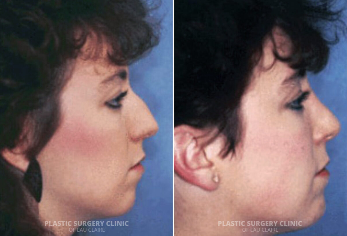 Rhinoplasty Before and After Photos in Eau Claire, Wisconsin, Patient 244