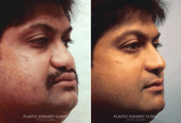 Rhinoplasty Before and After Photos in Eau Claire, Wisconsin, Patient 252