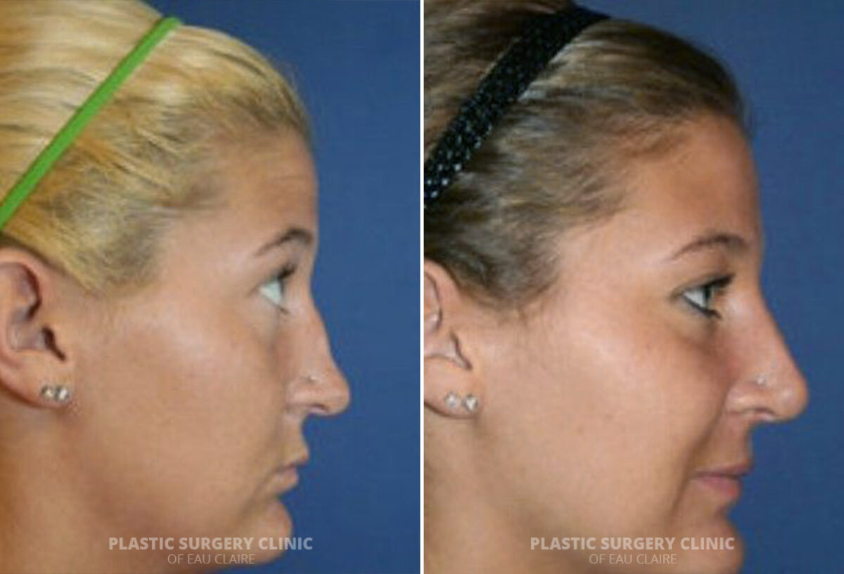 Rhinoplasty Before and After Photos in Eau Claire, Wisconsin, Patient 254