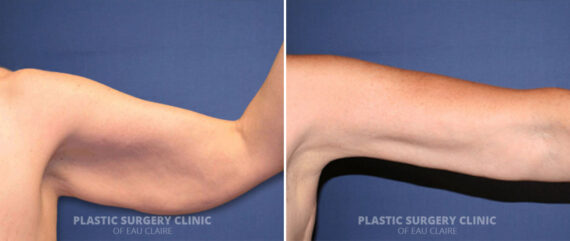 Arm Lift Before and After Photos in Eau Claire, Wisconsin