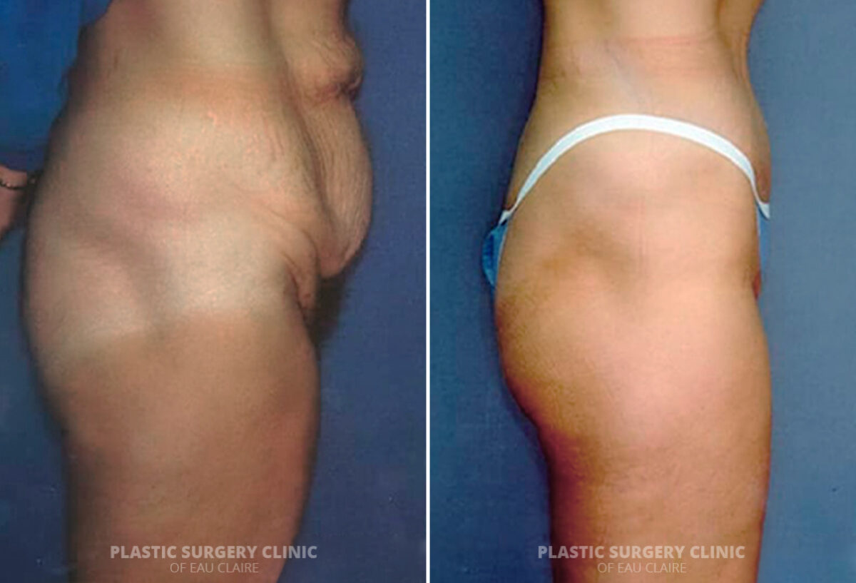 Tummy Tuck Before and After Photos in Eau Claire, Wisconsin, Patient 275