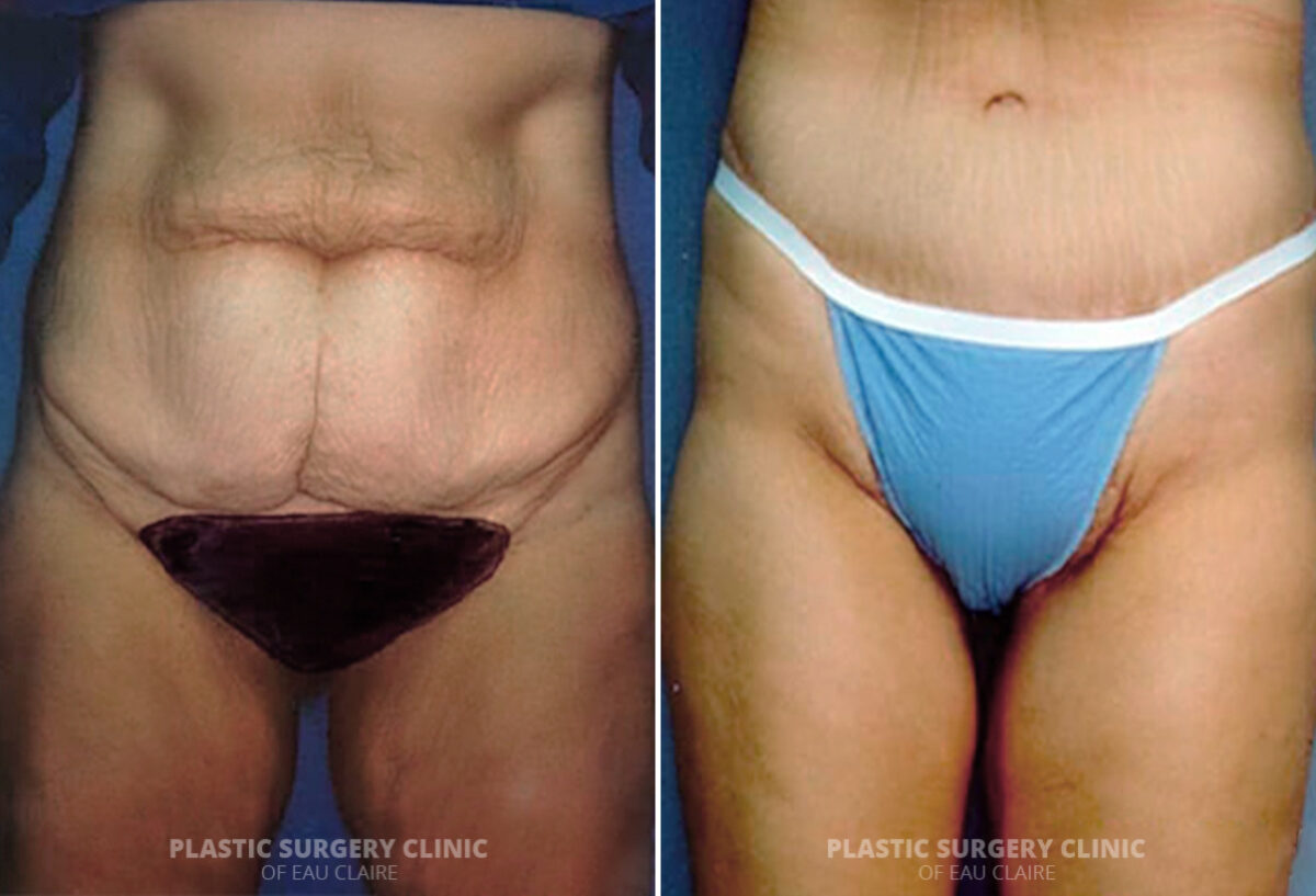 Tummy Tuck Before and After Photos in Eau Claire, Wisconsin, Patient 275