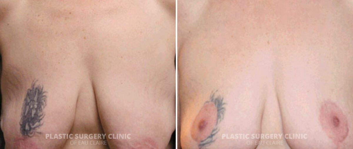 Breast Lift Before and After Photos in Eau Claire, Wisconsin, Patient 287