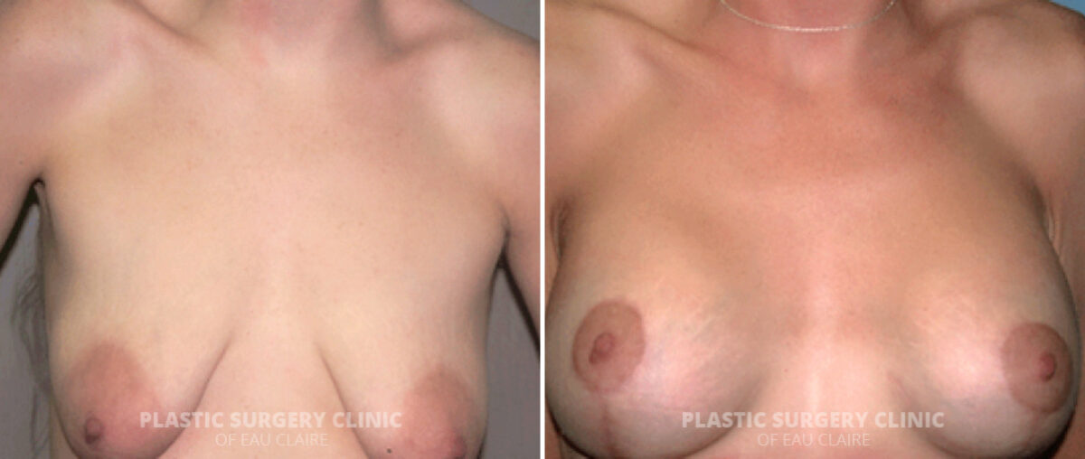 Breast Lift Before and After Photos in Eau Claire, Wisconsin, Patient 295