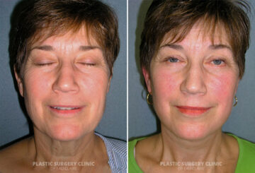 Facelift Before and After Photos in Eau Claire, Wisconsin, Patient 307