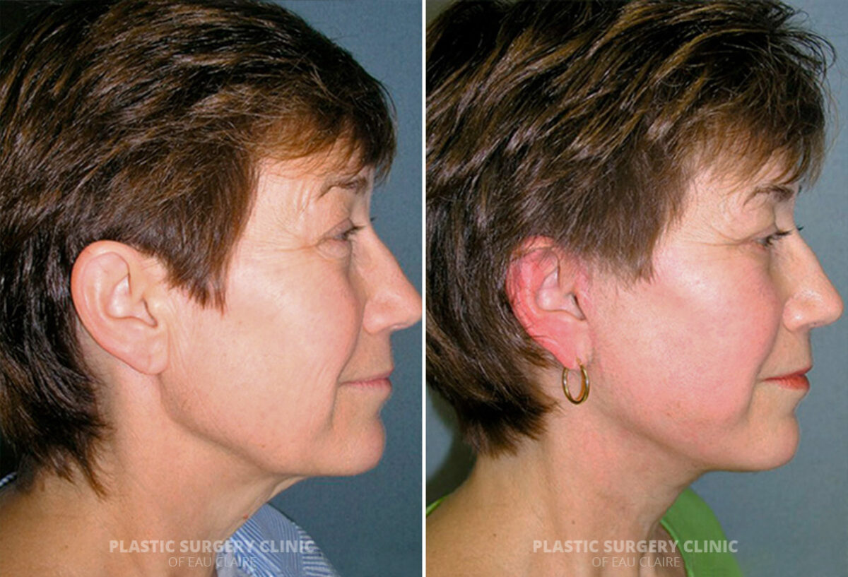 Facelift Before and After Photos in Eau Claire, Wisconsin, Patient 307