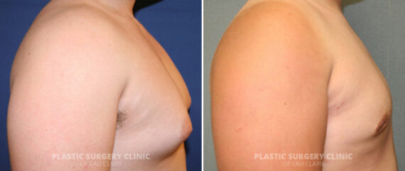 Male Breast Reduction Before and After Photos in Eau Claire, Wisconsin, Patient 321