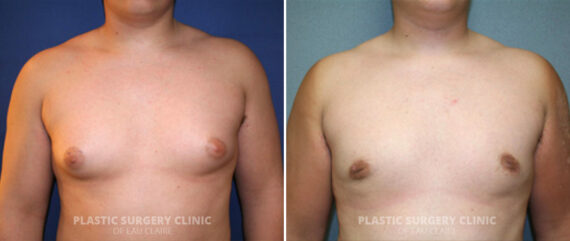 Male Breast Reduction Before and After Photos in Eau Claire, Wisconsin, Patient 321