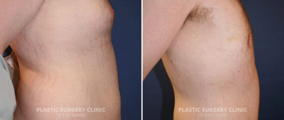 Male Breast Reduction Before and After Photos in Eau Claire, Wisconsin