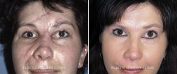 Scar Treatment Before and After Photos in Eau Claire, Wisconsin, Patient 353