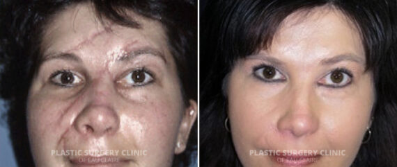 Scar Treatment Before and After Photos in Eau Claire, Wisconsin