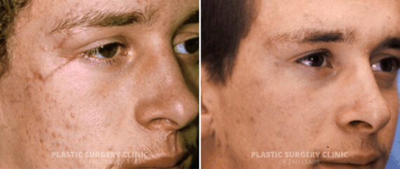 Scar Treatment Before and After Photos in Eau Claire, Wisconsin, Patient 359