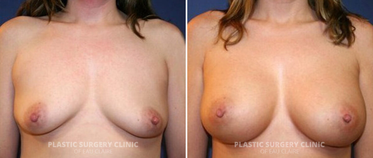 Breast Augmentation Before and After Photos in Eau Claire, Wisconsin, Patient 97