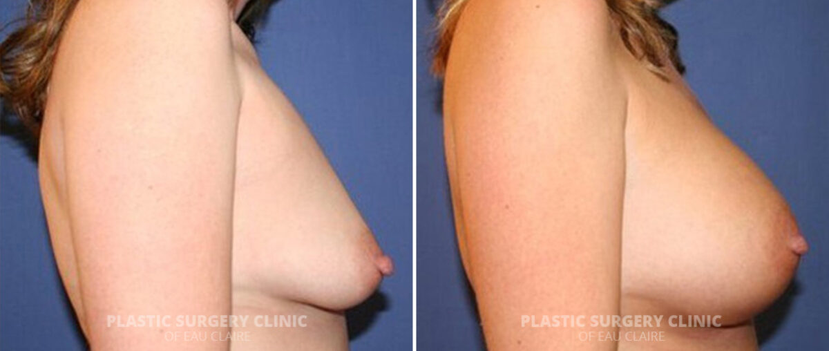 Breast Augmentation Before and After Photos in Eau Claire, Wisconsin, Patient 97